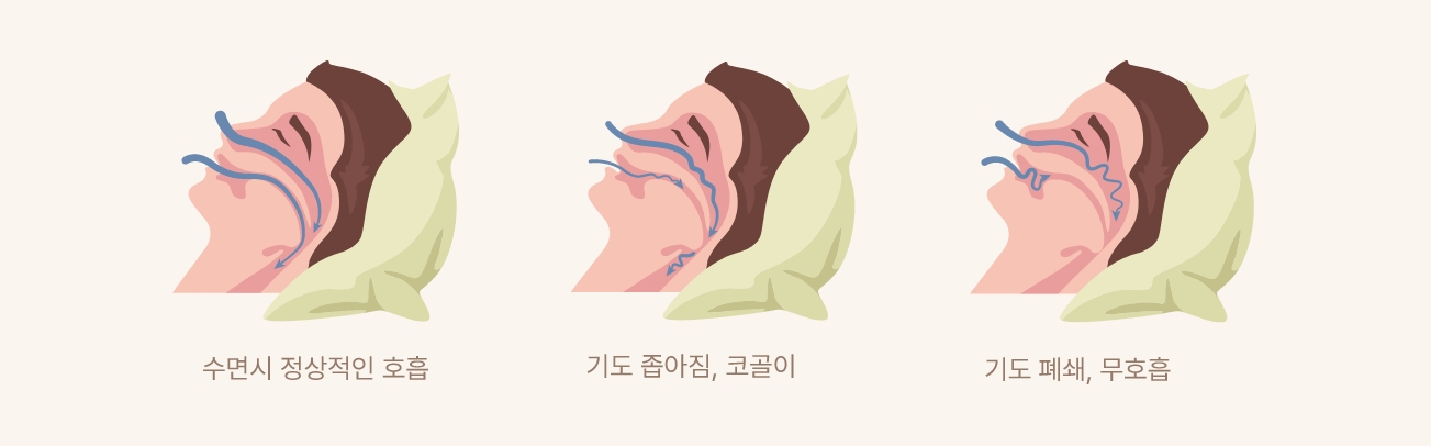 코골이이미지
